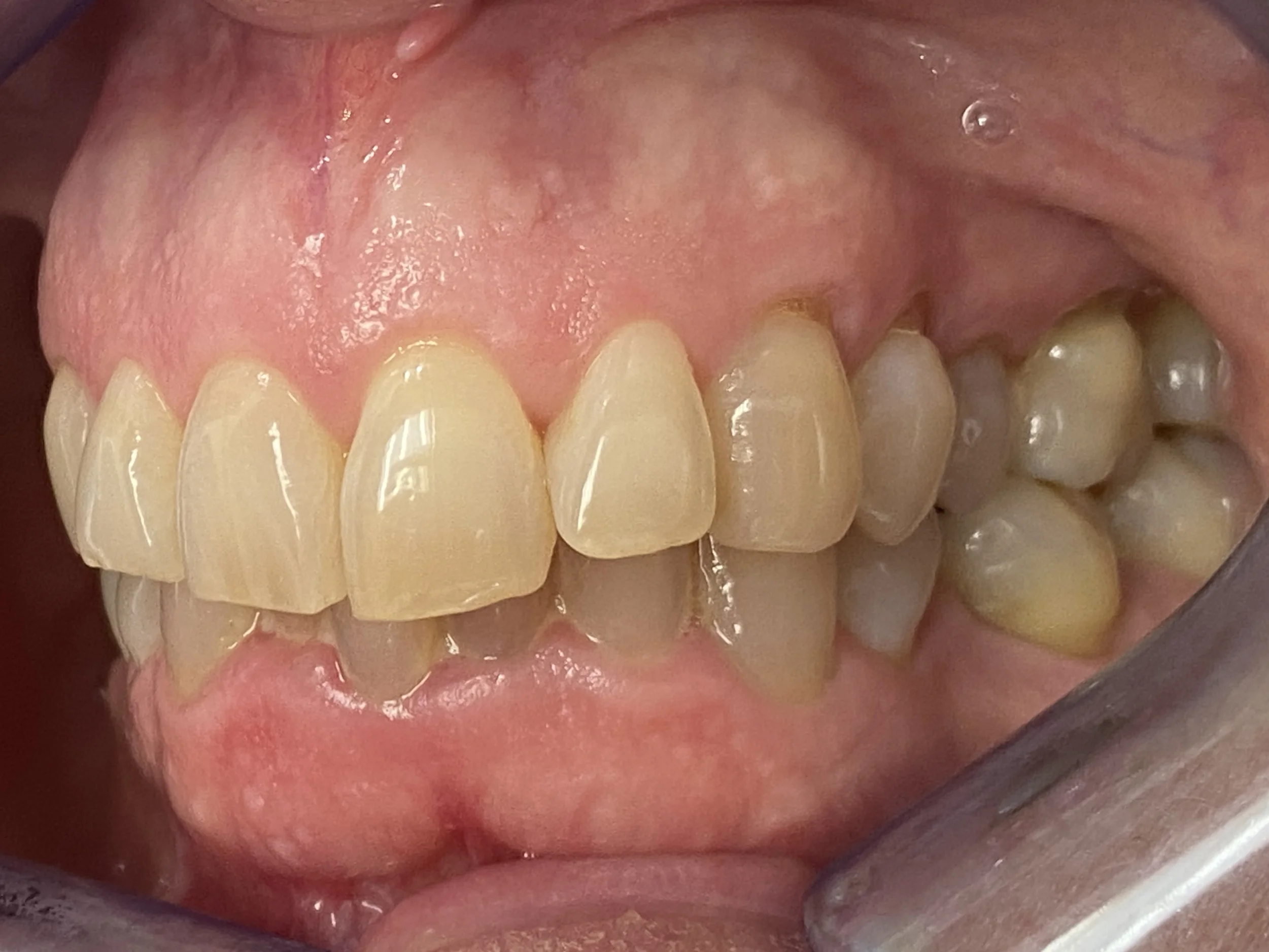 caries dental
